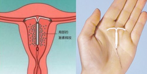 含孕激素的宫内节育器，作用示意图(左)和实物(右)