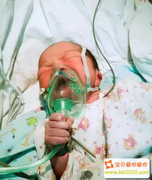 宝宝刚出生就手拿氧气罩吸氧