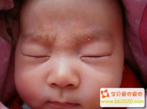 小儿脂溢性皮炎的种类 造成婴儿脂溢性皮炎的原因第1张