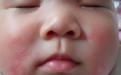宝宝湿疹是怎么引起的？婴儿湿疹用什么药及饮食上有哪些禁忌