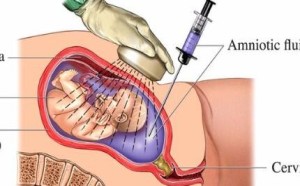 哪些孕妇需要做羊水穿刺 羊水穿刺什么时候做最好