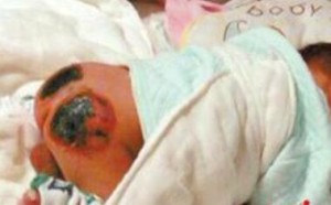 宝宝烫伤了怎么办？烫伤后怎么处理？