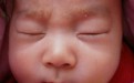 小儿脂溢性皮炎的种类 造成婴儿脂溢性皮炎的原因