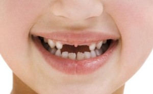 孩子的乳牙有龋洞需要补吗？龋洞对孩子有什么影响