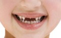 孩子的乳牙有龋洞需要补吗？龋洞对孩子有什么影响