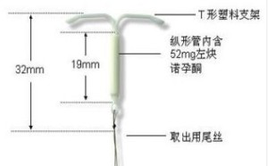 女性节育环上环全过程揭秘(组图)