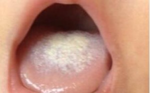 如何区分舌苔与鹅口疮?婴儿舌苔怎么清除掉? 如何区分舌苔与鹅口疮?婴儿舌苔怎么清除掉?