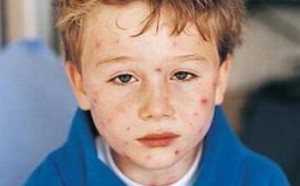 水痘的症状和治疗方法