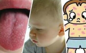 小儿猩红热是怎么引起的？猩红热居家防护对策