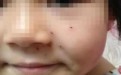 郑州6岁女童不会做题被老师体罚，脸被扎6个洞   