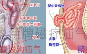 小儿疝气切勿置之不理 如何应对小儿疝气(图) 小儿疝气切勿置之不理 如何应对小儿疝气(图)