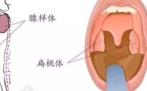 小孩腺样体肥大并非都要做手术 腺样体过度肥大才是“病”