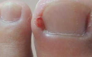 嵌甲和甲沟炎的区别 嵌甲性甲沟炎最佳治疗方法根治（图）