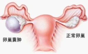卵巢囊肿影响怀孕吗 需要手术吗 卵巢囊肿影响怀孕吗 需要手术吗