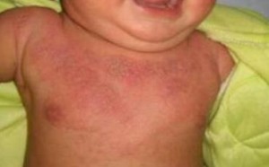 异位性皮炎常识:判别儿童异位性皮炎的方法 异位性皮炎常识:判别儿童异位性皮炎的方法