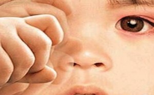 家长注意!谨防孩子患上红眼病