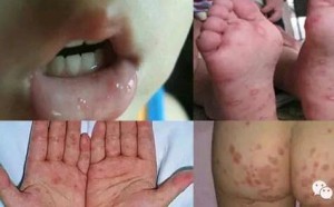 季节交替 小儿手足口怎么样预防和治疗？