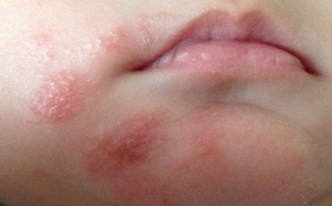 专家教你辨别宝宝湿疹及最佳治疗时间