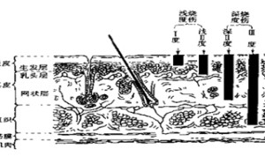 儿童手背烫伤病例解析 病程解说