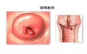 切除宫颈息肉手术全过程 惊惊惊! 切除宫颈息肉手术全过程 惊惊惊!