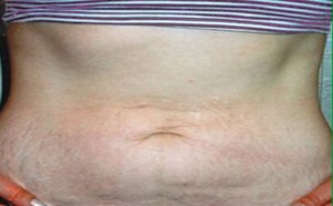 孕妇产后妊娠纹预防和治疗的方法 孕妇产后妊娠纹预防和治疗的方法