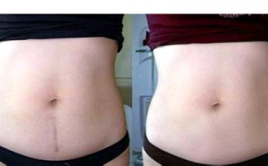 去除孕后肚皮皱纹(妊娠纹)的有效方法 去除孕后肚皮皱纹(妊娠纹)的有效方法