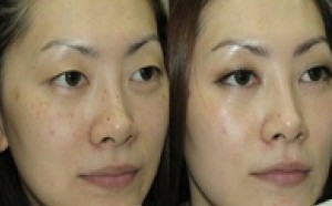 轻松治疗孕妇黄褐斑 雀斑 痣