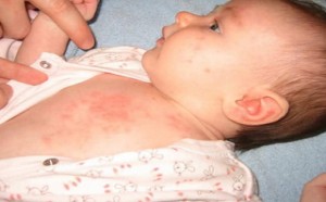 宝宝常见痱子的预防