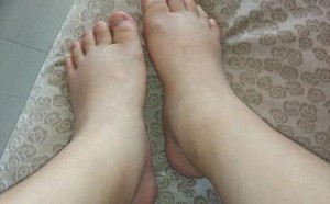 准妈妈远离孕期水肿需要从8个生活细节入手 准妈妈远离孕期水肿需要从8个生活细节入手