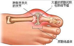 痛风的病因是什么?痛风如何根治? 痛风的病因是什么?痛风如何根治?