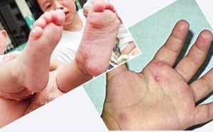 小儿手足口病症状图片 小儿手足口病症状图片