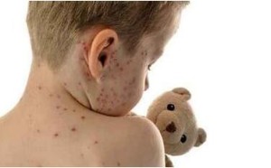 孩子出水痘不能吃什么 有哪些饮食禁忌 孩子出水痘不能吃什么 有哪些饮食禁忌