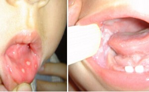 宝宝鹅口疮症状 如何预防和治疗小儿鹅口疮(图) 宝宝鹅口疮症状 如何预防和治疗小儿鹅口疮(图)