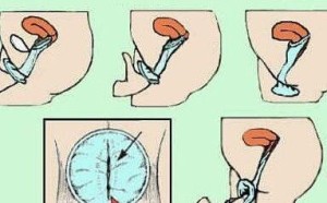 避孕套怎么戴?女用避孕套真人版使用方法演示(图) 避孕套怎么戴?女用避孕套真人版使用方法演示(图)