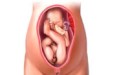 臀位分娩的风险_臀位胎儿怎样分娩更安全(组图）