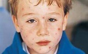 麻疹的早期症状与儿童感冒类似，家长们别忽视