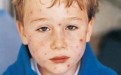 麻疹的早期症状与儿童感冒类似，家长们别忽视