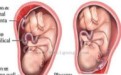 孕妇胎盘前置怎么办？前置胎盘有哪些危害及治疗方法