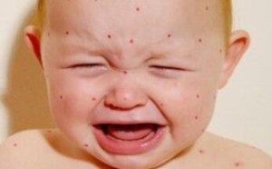 什么是幼儿急疹? 教你快速识别幼儿急疹的方法