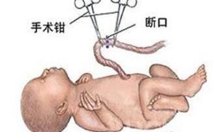 什么情况下需要选择剖腹产 剖腹产手术如何进行?(图) 什么情况下需要选择剖腹产 剖腹产手术如何进行?(图)