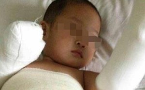 两岁娃跌入滚烫开水全身严重烫伤 造成儿童烫伤的常见原因 两岁娃跌入滚烫开水全身严重烫伤 造成儿童烫伤的常见原因