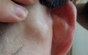 耳朵后面长了个硬包是怎么回事及治疗的方法 耳朵后面长了个硬包是怎么回事及治疗的方法