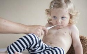 小孩子出水痘要注意些什么？