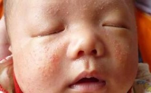 新生儿如何避免湿疹 如何有效消除湿疹? 新生儿如何避免湿疹 如何有效消除湿疹?