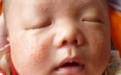 新生儿如何避免湿疹 如何有效消除湿疹？