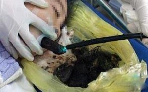 6岁女童患异食癖 爱上吃头发 6岁女童患异食癖 爱上吃头发