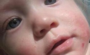 宝宝长奶癣怎么办？帮宝宝摆脱长奶癣的方法