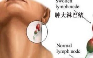 淋巴癌发病隐蔽早期症状似感冒 如何预防与治疗淋巴癌