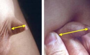 孩子小鸡太小是怎么回事？造成隐匿阴茎的原因（图）