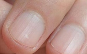 手指甲上有竖纹是怎么回事?出现竖纹吃什么食物好? 手指甲上有竖纹是怎么回事?出现竖纹吃什么食物好?